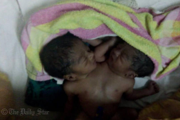 ঢাকা মেডিকেলের পেডিয়াট্রিক সার্জারি ইউনিটে রেখে যাওয়া দুই শিশু। ছবি: শাহীন মোল্লা