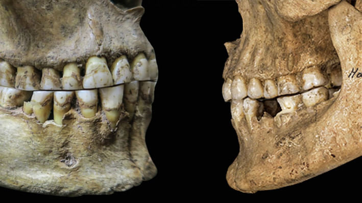 একজন প্রাচীন নারীর চোয়ালে (বামে) ওভারবাইট দেখা না গেলেও ব্রোঞ্জ যুগের একজন পুরুষের চোয়ালে (ডানে) ওভারবাইট দেখা যাচ্ছে। ছবি: সংগৃহীত