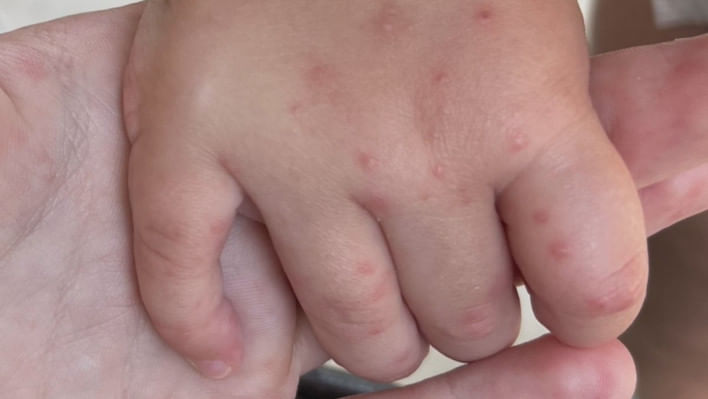 হ্যান্ড ফুট অ্যান্ড মাউথ ডিজিজ