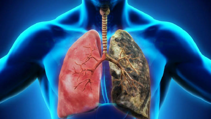 ফুসফুসের ক্যানসার