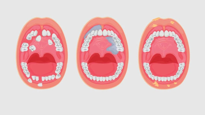 মুখের ক্যানসার