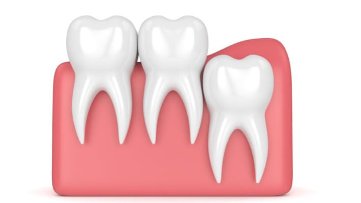 আক্কেল দাঁত