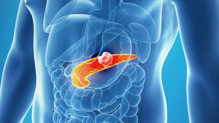 অগ্ন্যাশয়ের ক্যানসার 