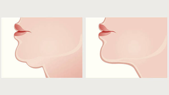 চিবুক ফুলে ব্যথা, টনসিল নাকি অন্যকিছু?