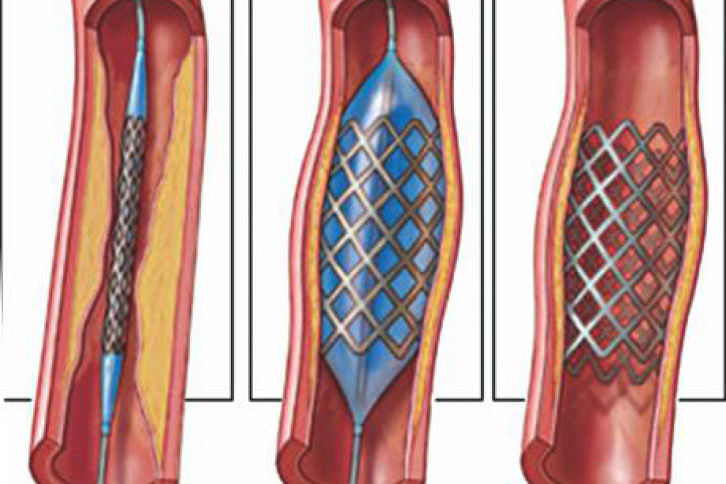 Stents Stents