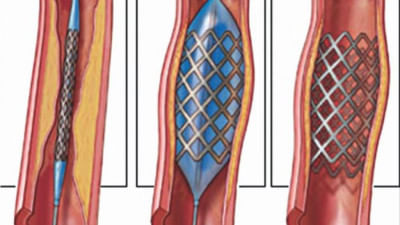 হার্টের চিকিৎসা: স্টেন্টের দাম বৃদ্ধিতে রোগীর ওপর বাড়তি চাপ
