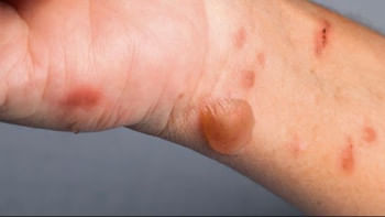 ‘টমেটো ফ্লু’ নামটি এসেছে এ রোগের মূল উপসর্গ থেকে। এ রোগে আক্রান্ত হলে দেহের বিভিন্ন অংশে টমেটো আকৃতির ফোস্কা দেখা দেয়। ছবি: সংগৃহীত