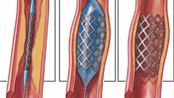 হার্টের চিকিৎসা: স্টেন্টের দাম বৃদ্ধিতে রোগীর ওপর বাড়তি চাপ