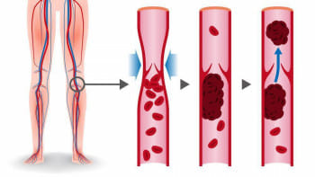ডিভিটি বা শিরায় রক্ত জমাট বাঁধা