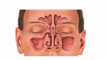 সাইনোসাইটিস