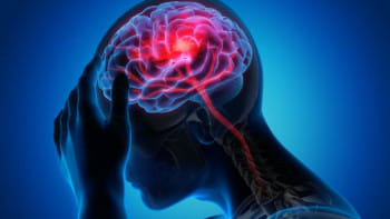 কম বয়সে স্ট্রোক