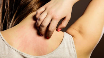 অ্যালার্জি