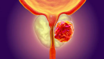 প্রোস্টেট ক্যানসার