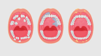 মুখের ক্যানসার