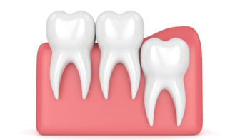 আক্কেল দাঁত