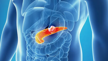 অগ্ন্যাশয়ের ক্যানসার 