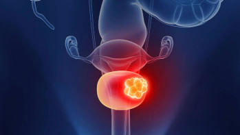 মূত্রথলির ক্যানসার