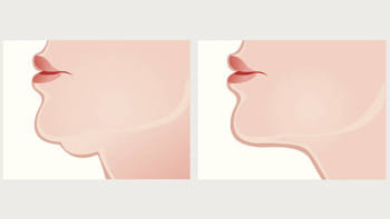 চিবুক ফুলে ব্যথা, টনসিল নাকি অন্যকিছু?